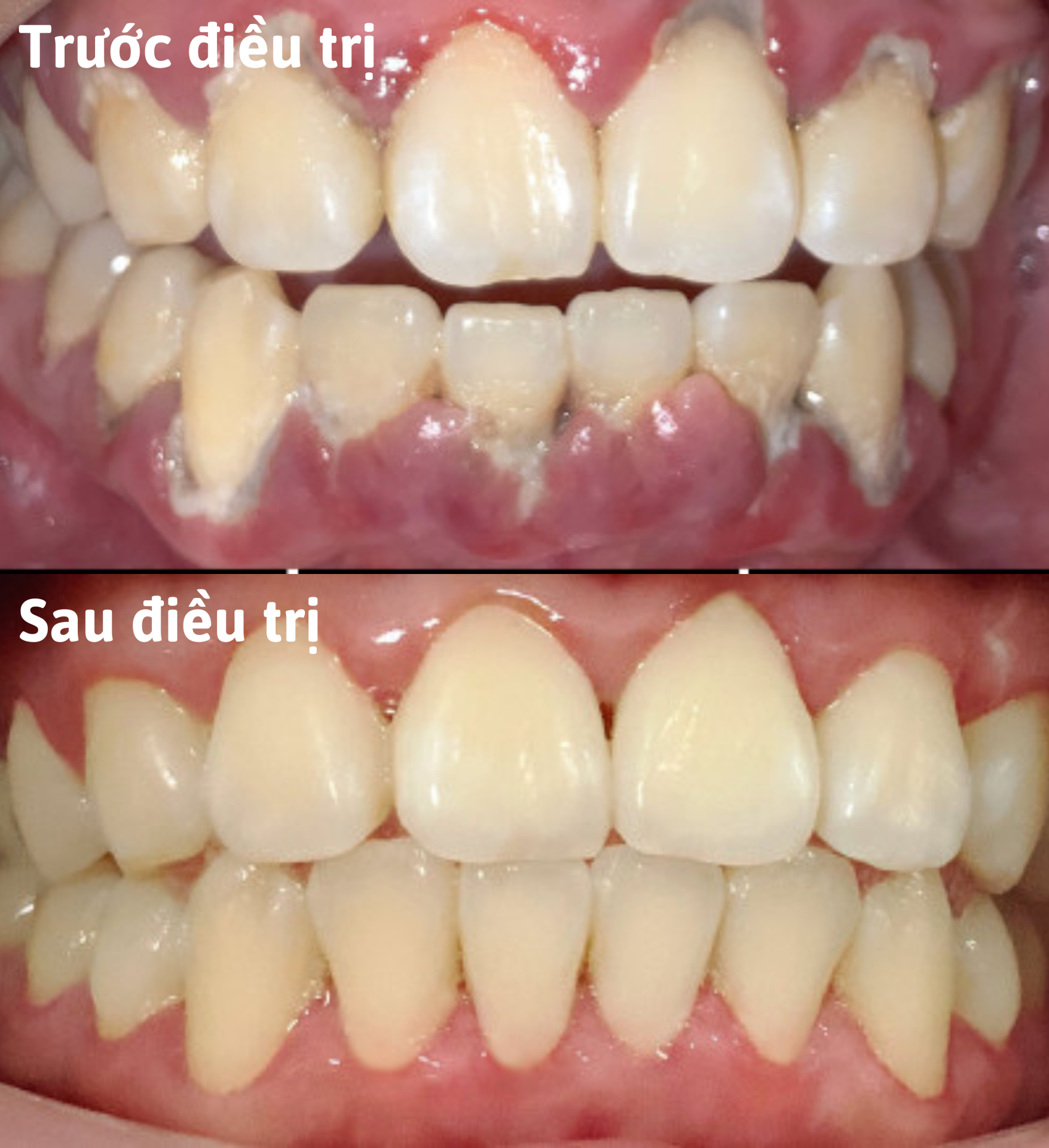 Sau khi điều trị bằng Lusmile