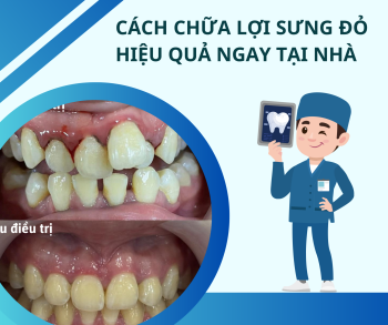 Cách Chữa Lợi Sưng Đỏ Hiệu Quả Ngay Tại Nhà