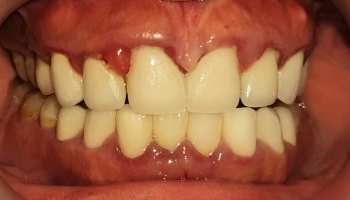 Những lưu ý sau khi bọc răng sứ thẩm mỹ