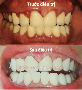 Nguyên nhân bị viêm lợi sau khi bọc răng sứ và cách khắc phục