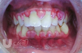 Viêm lợi phì đại là gì? Nguyên nhân gây bệnh và cách chữa đơn giản tại nhà